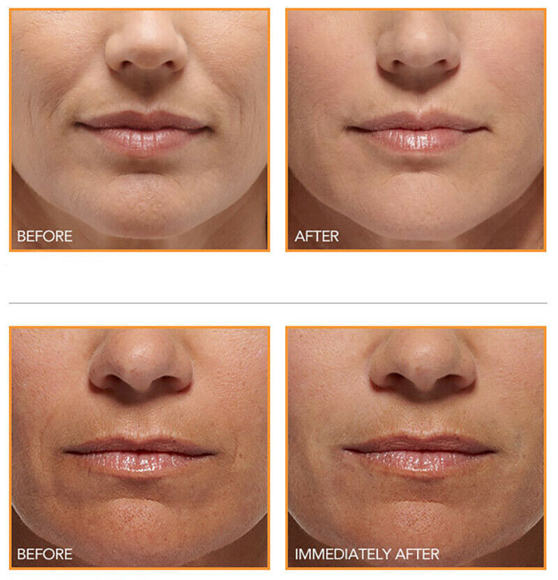 HYALURONIC ACID 100% Pure Anti Aging Hydrating Serum, Plumps Wrinkles Fine Lines