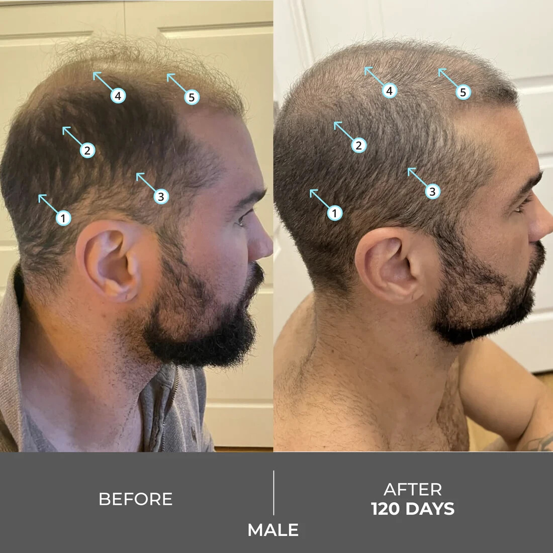 Revita Extra Strength Hair Density Shampoo for Hair Growth for Men and Women