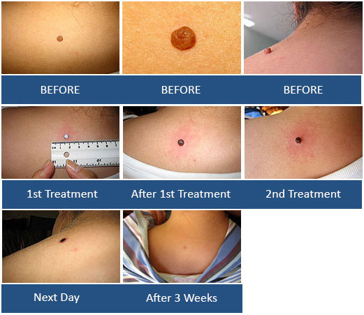 Mole Remover, Wart Remover, Skin Tag remover, Wart Mole Vanish™ Award Winning