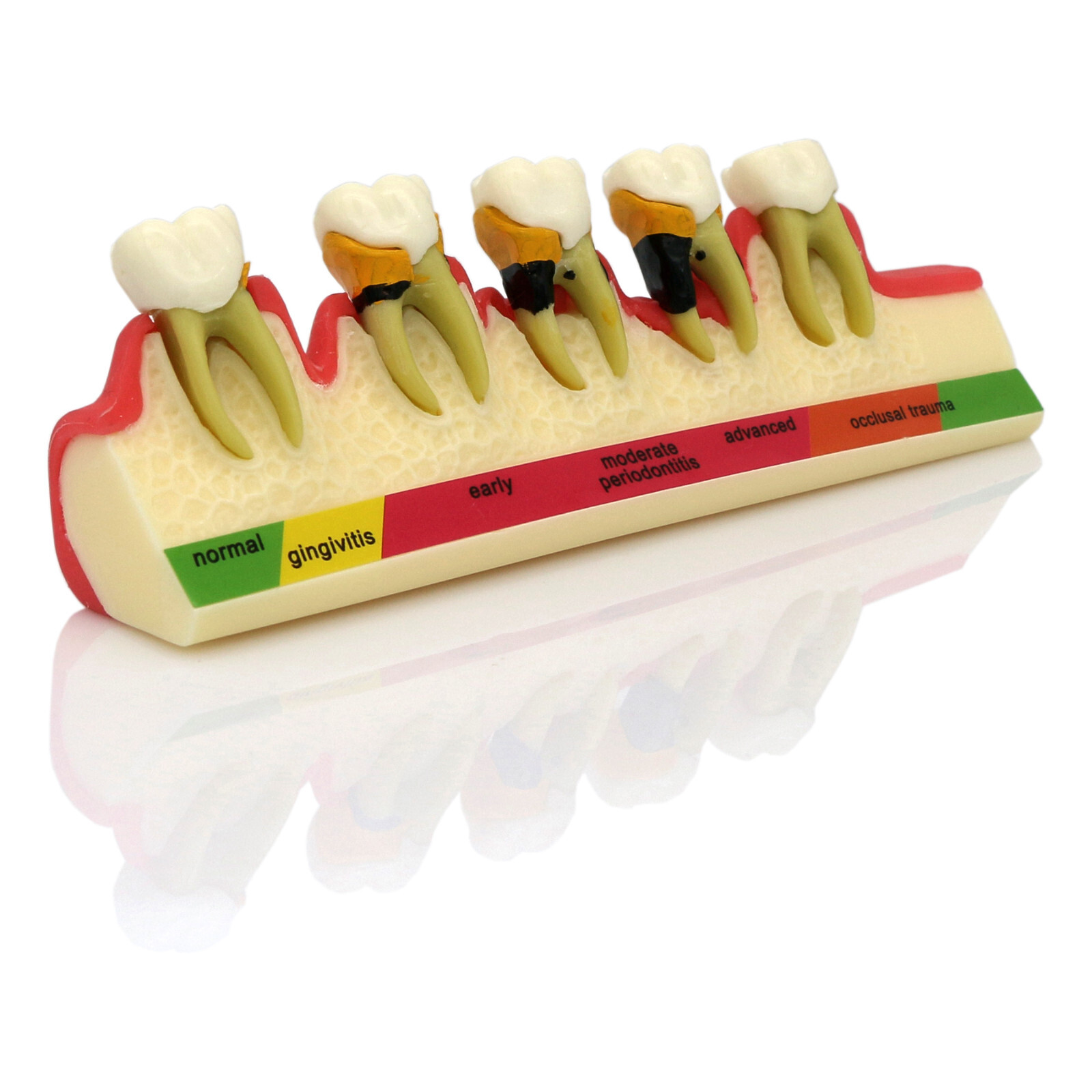 Dental Teeth Model Pathological Typodont Periodontics Endo Disease Assort Demo