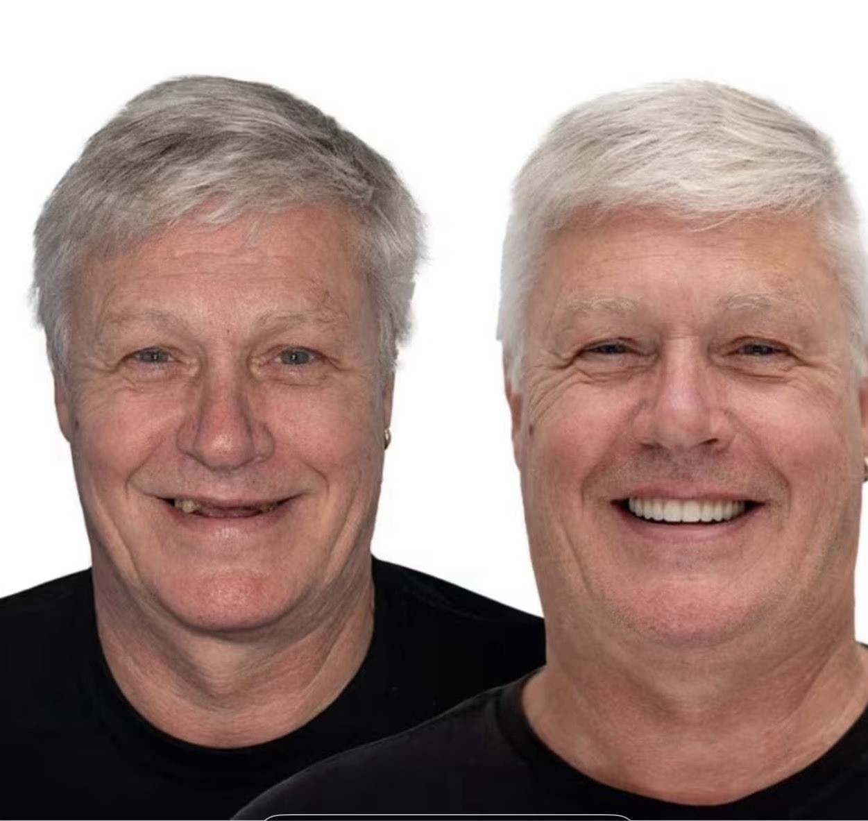 Dentures Cosmetic Teeth Mold, Fit over Teeth or Fill in Gaps Ships from USA