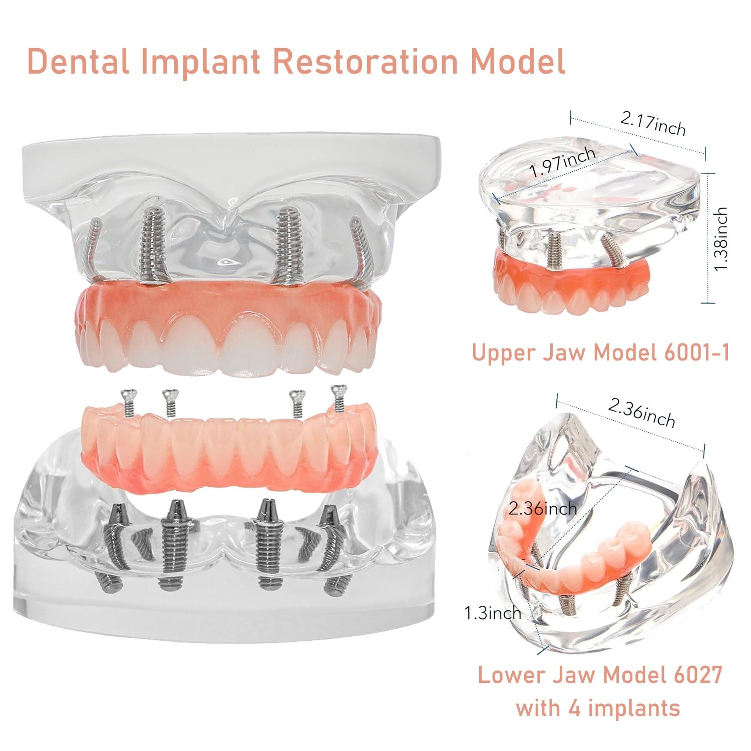 US Dental All-on-4 Overdenture Implant Model, Upper/Lower Jaw-Clear,With 4 Screw