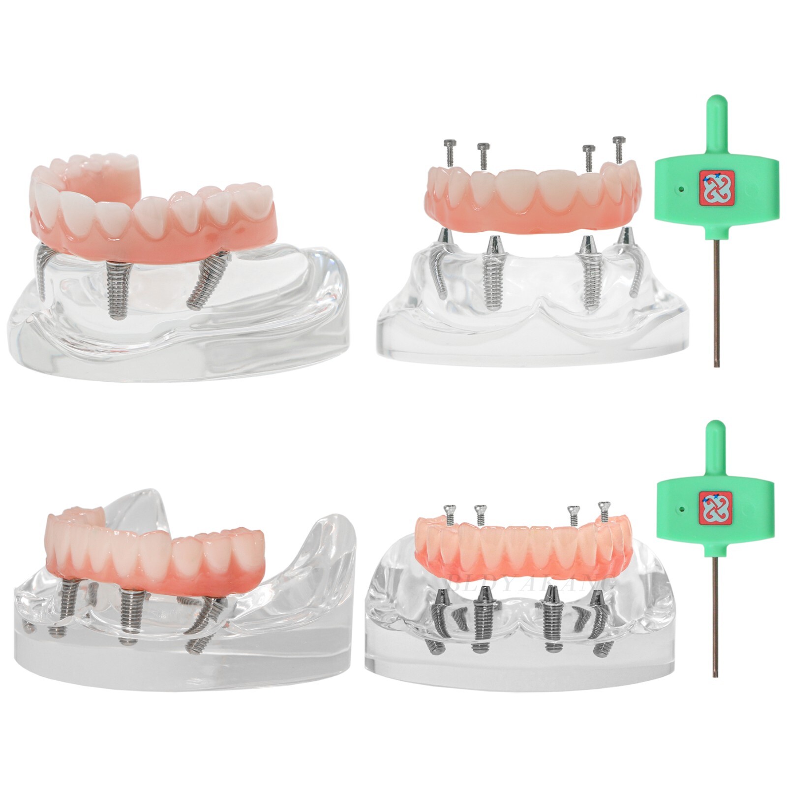 Dental Implant Typodont Teeth Restoration Model Series Overdenture Practice Demo