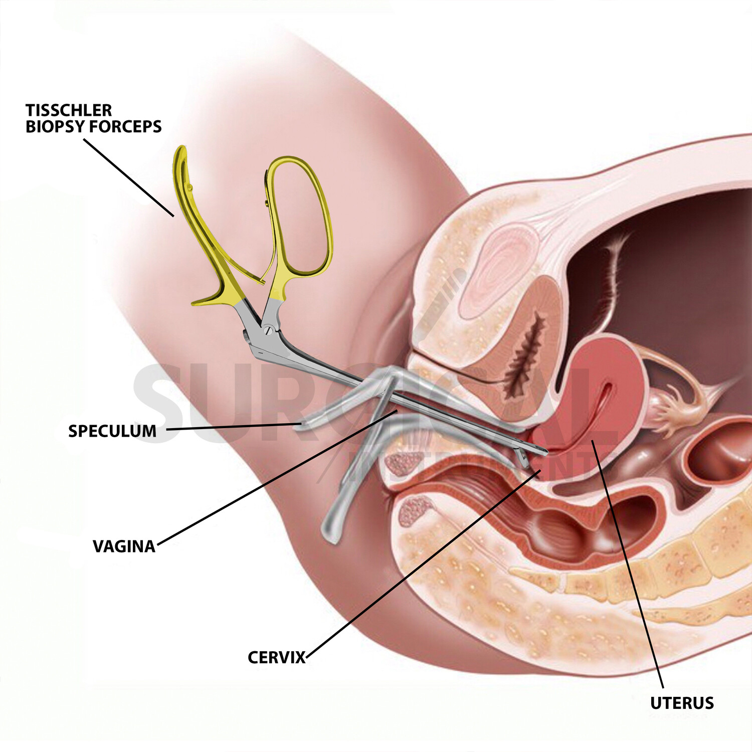 Tischler-Morgan Biopsy Forceps 3mmx7mm Bite 25cm Gold Handle Gynecology Surgical