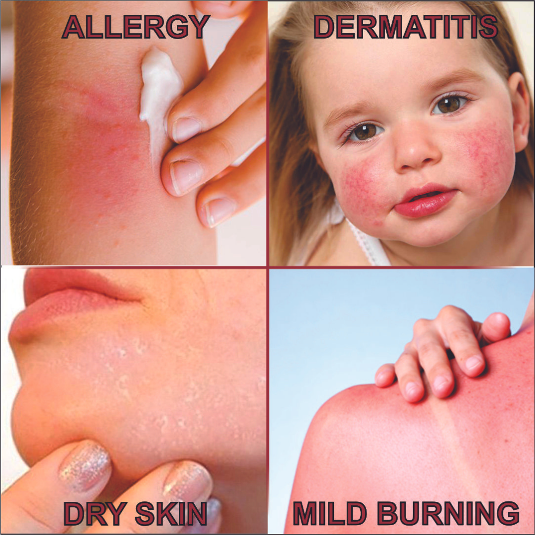 Quatriderm* Crema NF 1% Hydrocortisone - Anti-Itch Cream With Aloe Vera