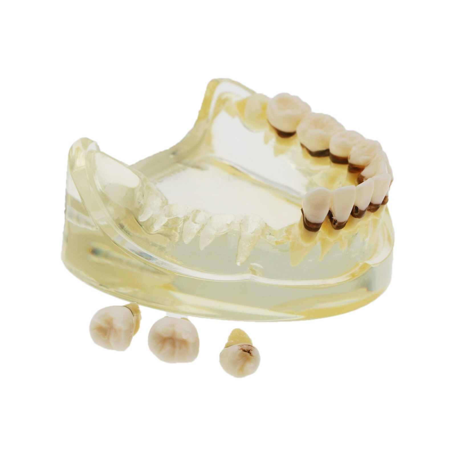 Dental Adult Periodontal Disease Pathological Teeth Typodont Model Removable Gum