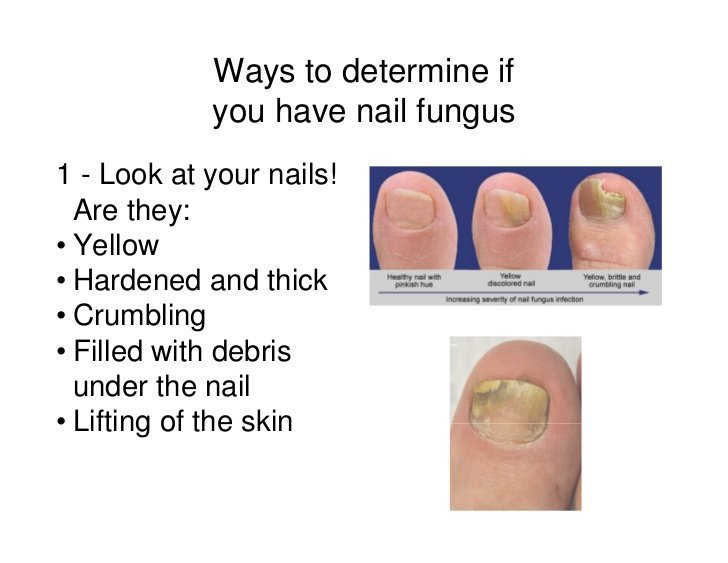 Nail Fungus Treatment For Toe and Finger Nail Fungal Infections #1 Natural Cure
