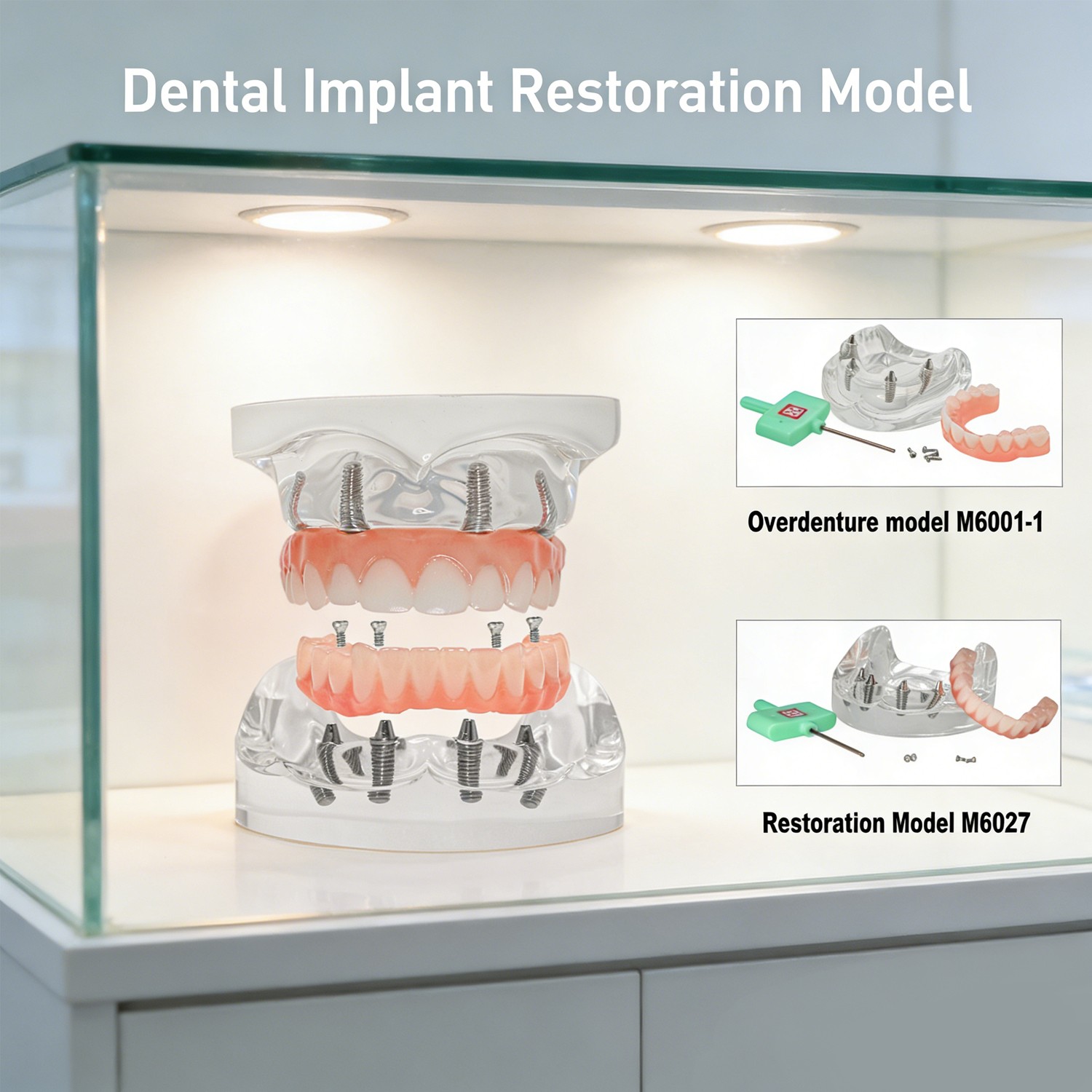 US Dental All-on-4 Overdenture Implant Model, Upper/Lower Jaw-Clear,With 4 Screw