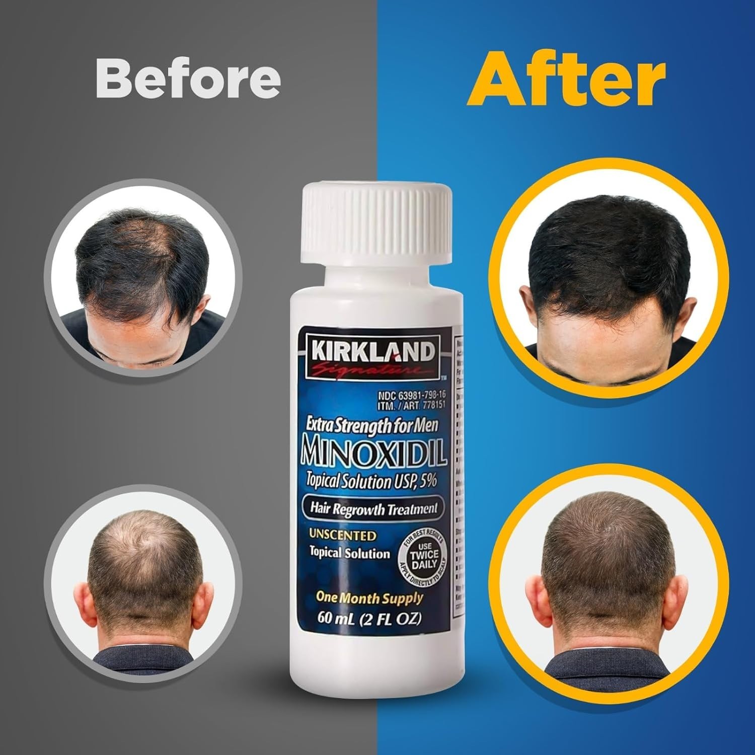 Kirkland Minoxidil 5% Extra Strength Mens 6 Month Bottles Hair Regrowth Solution