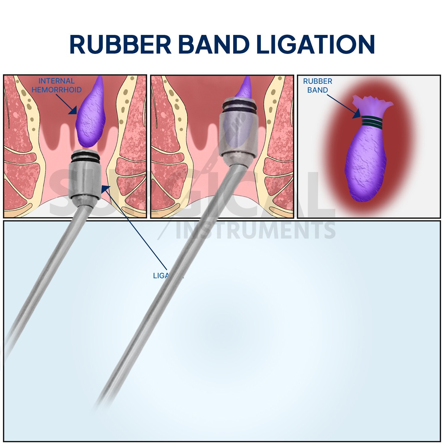 Hemorrhoid Suction Ligator Down Angle With 100 Latex Bands Surgical Instruments