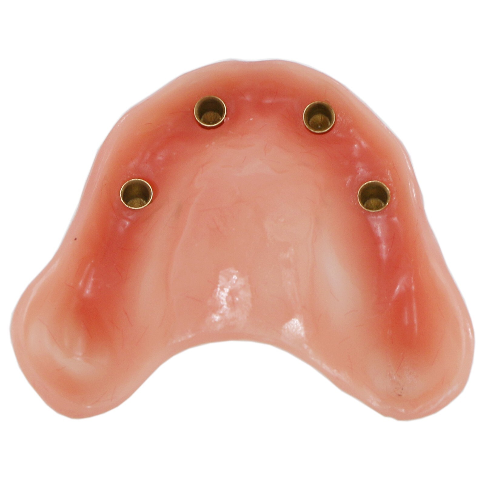 US Dental Implant Teeth Model Overdenture Restoration With4 Implants Upper Lower