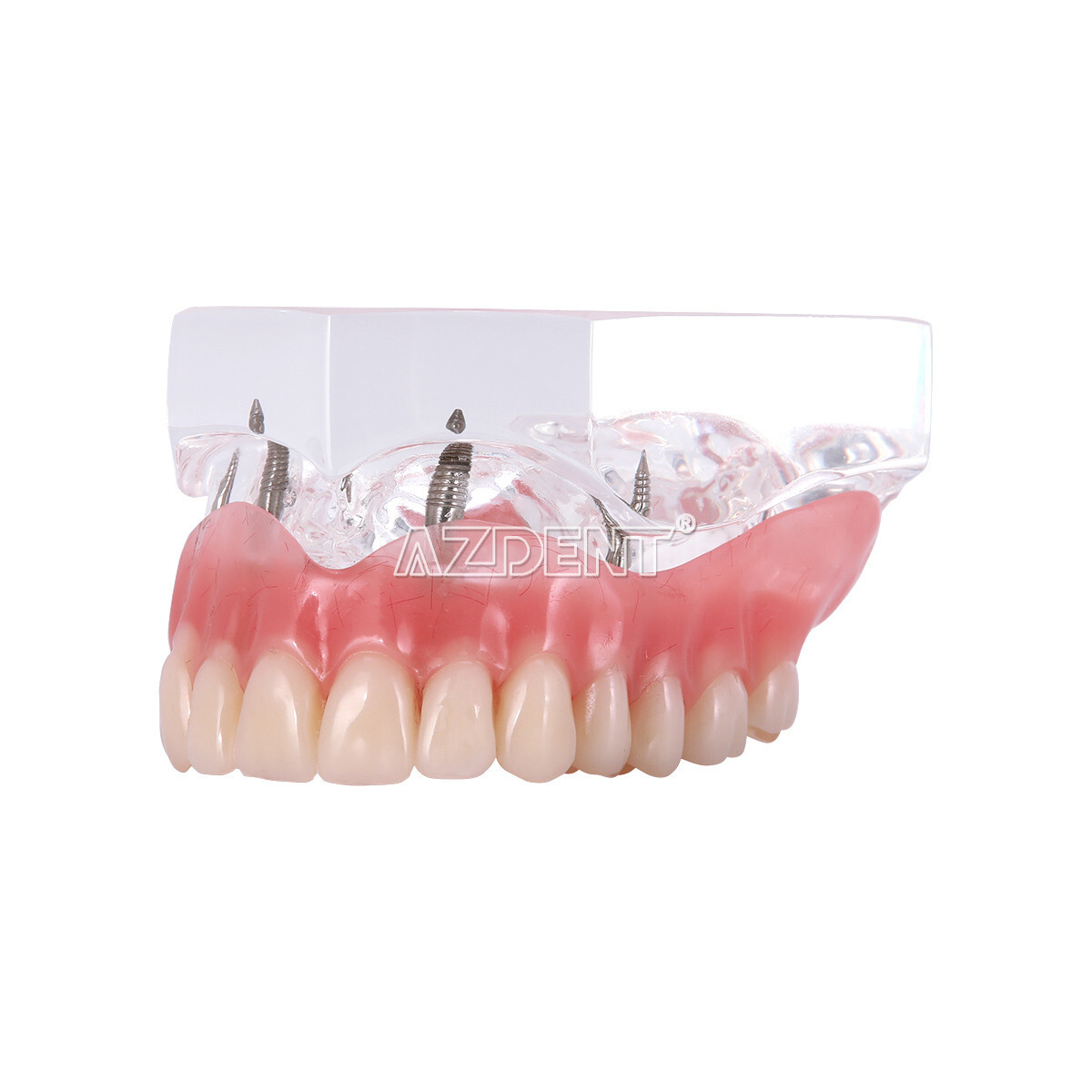 Dental Overdenture Implant Teeth Model Denture with implant Demonstration Clear