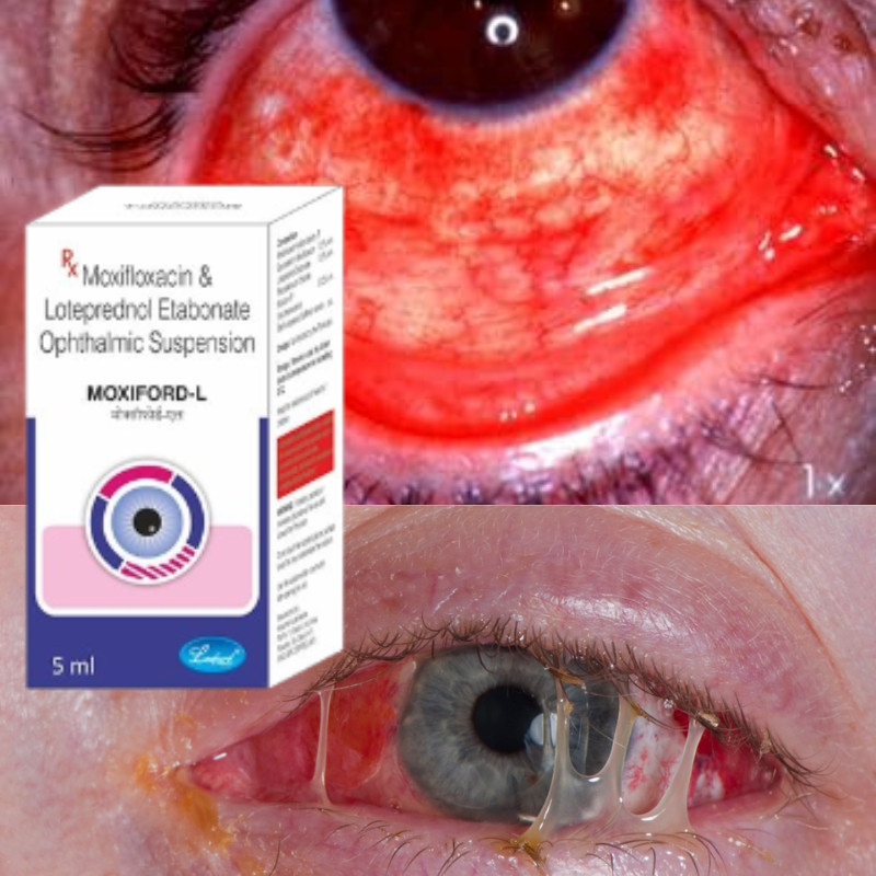 Eye Drops 5ml for Conjunctivitis & Eye Wash & Complete Eye Care free shipping