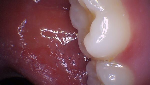 PerfectCam HD Intraoral Camera, USB Dental Camera, Free Capture Button Software.