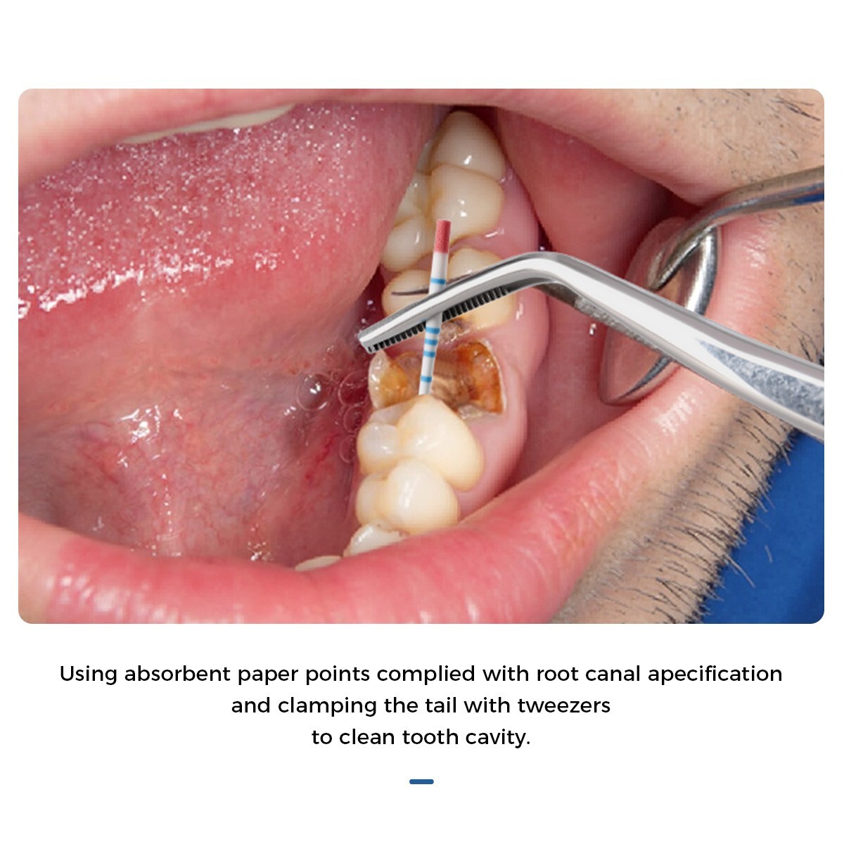 Puntas de papel absorbente dental y puntas de gutapercha con escala Conicidad F#