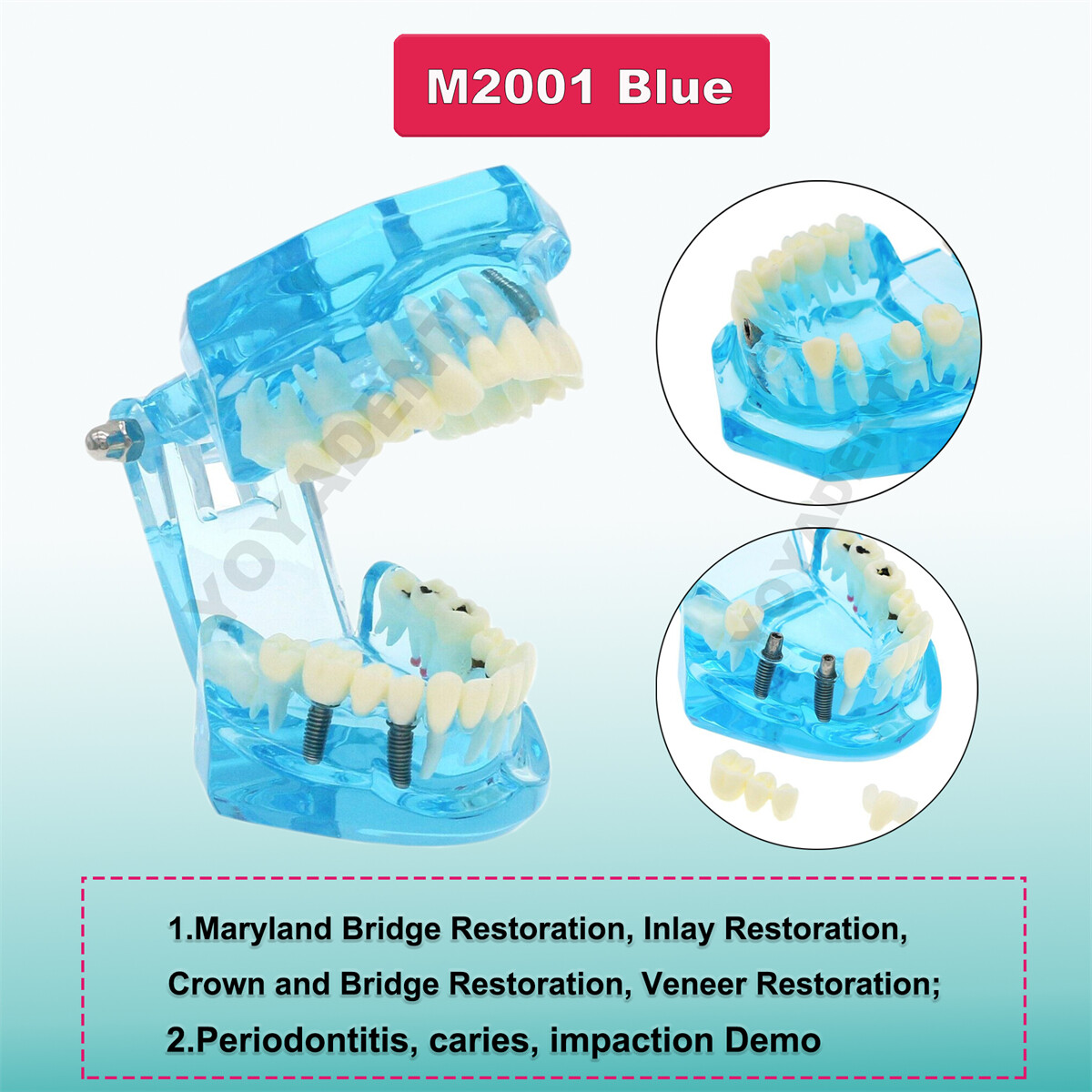 US Dental Teeth Model Ortho Implant Practice Teaching With Implants Demo Model