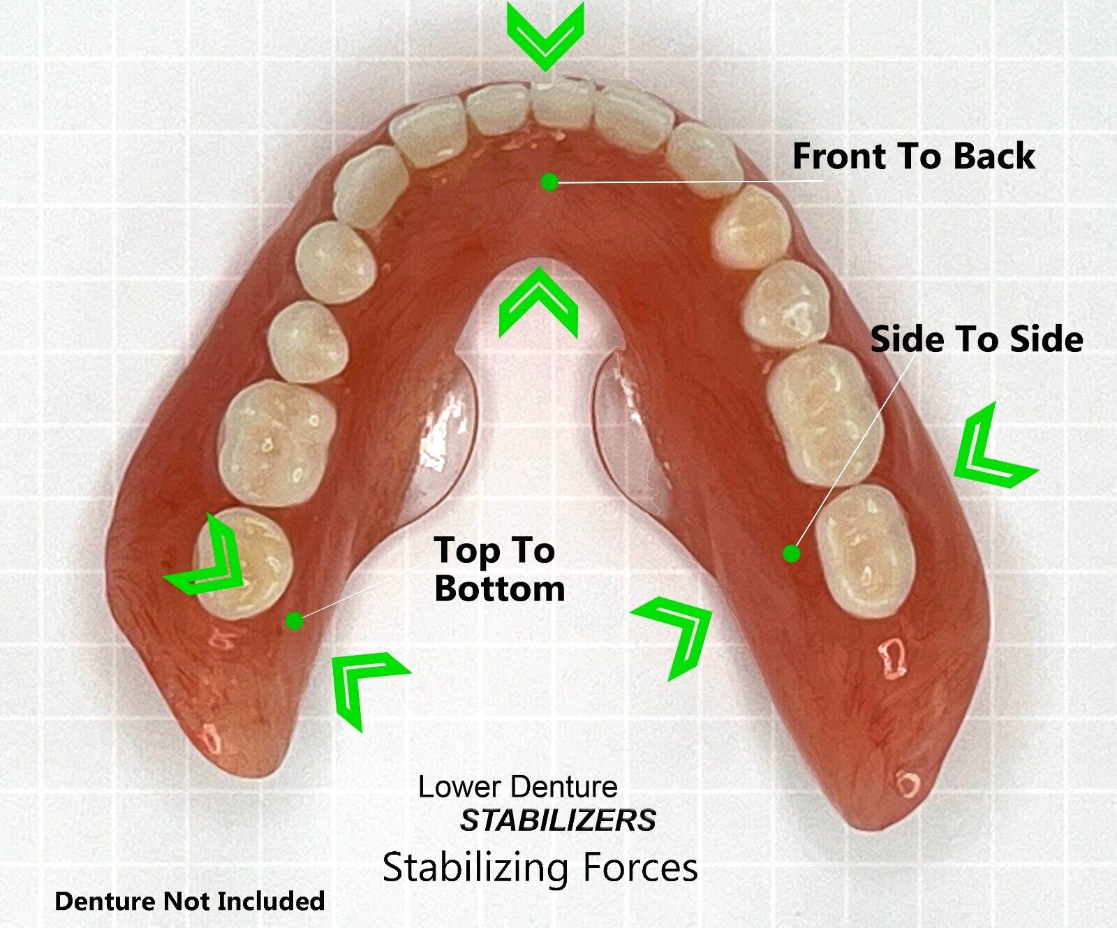Lower Denture Stabilizers DIY Kit-Affordable Denture Stabilization