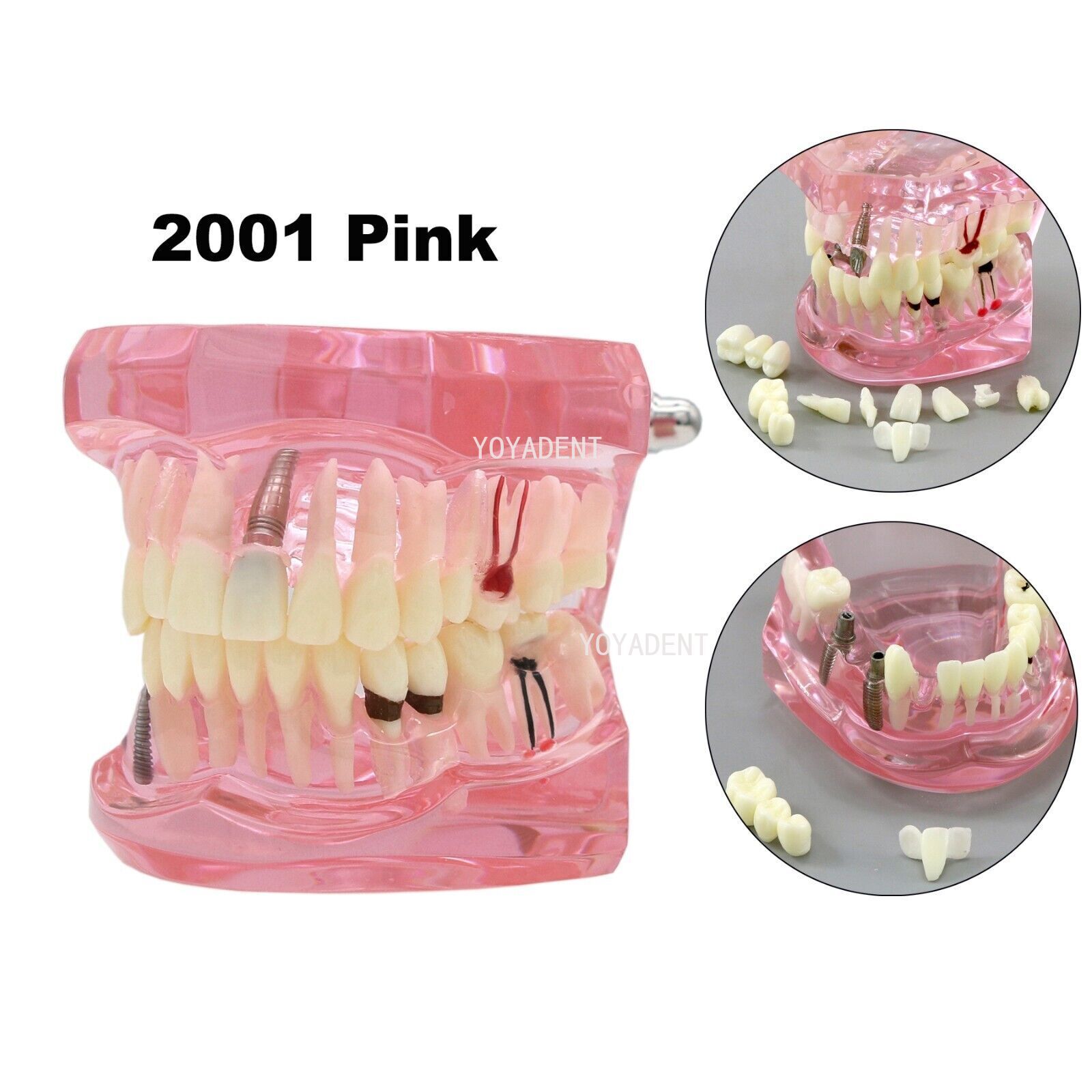 US Dental teeth Model Preparation Training Teaching Ortho Implant Typodont Demo