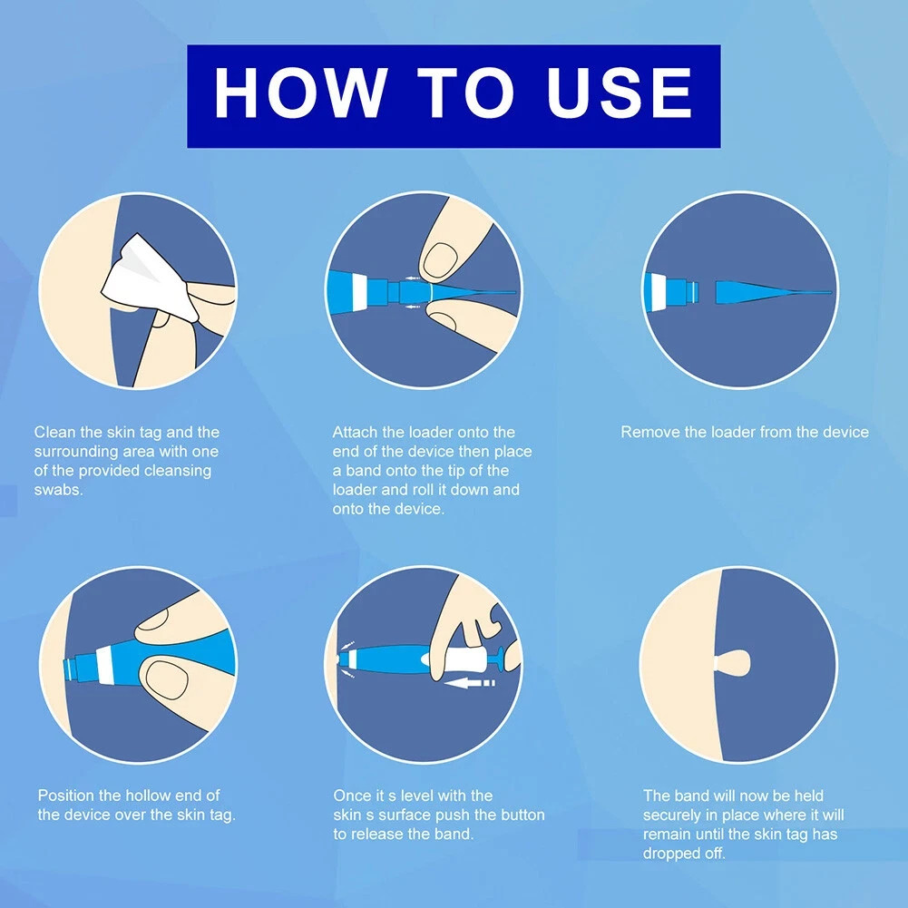 Auto Micro Skin Tag Remover Device Kit Safe Painless Removal 2-8 mm Band Tool