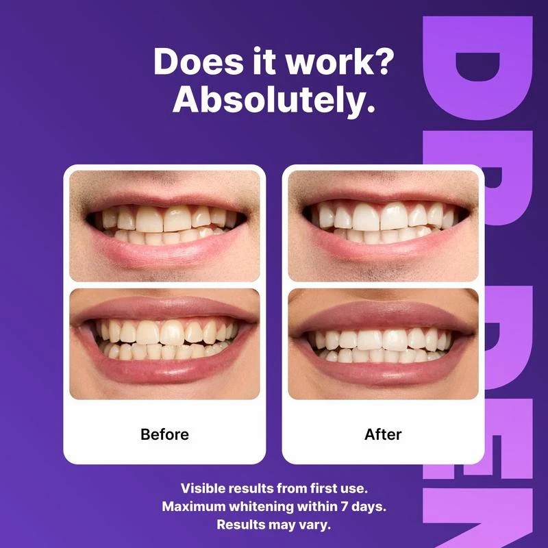 DRDENT Purple Teeth Whitening Strips - 7/21 Whitening Sessions - Safe for Enamel