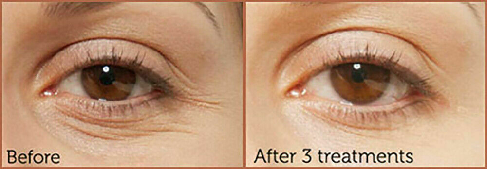 HYALURONIC ACID 100% Pure Anti Aging Hydrating Serum, Plumps Wrinkles Fine Lines