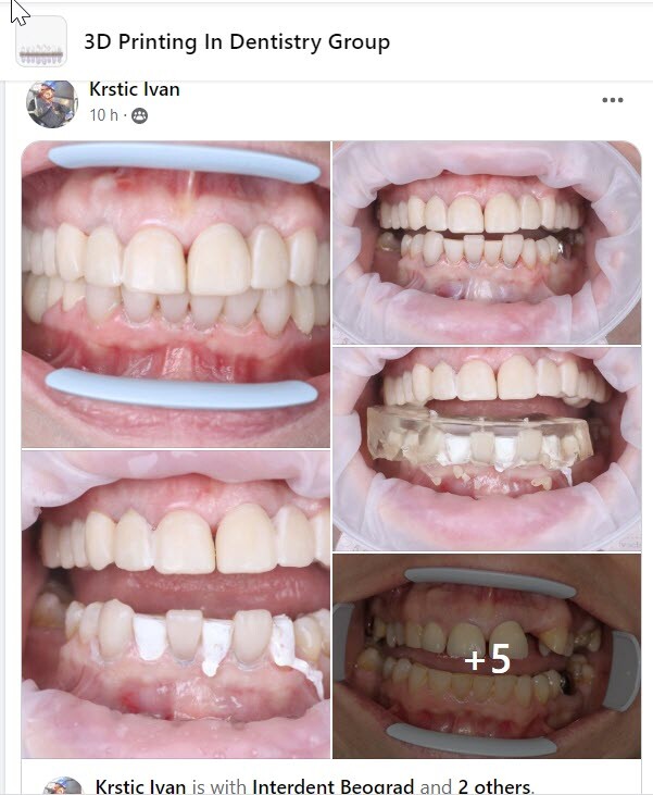 DLP SLA LCD 3d printer permenant crown - teeth resin ..