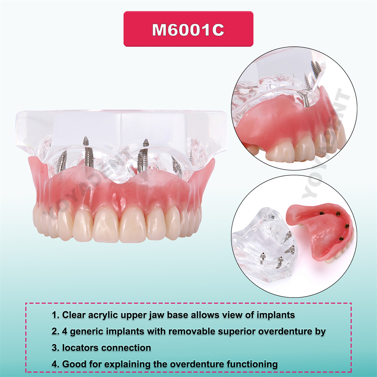 US Dental Implant Teeth Model Overdenture Restoration With4 Implants Upper Lower