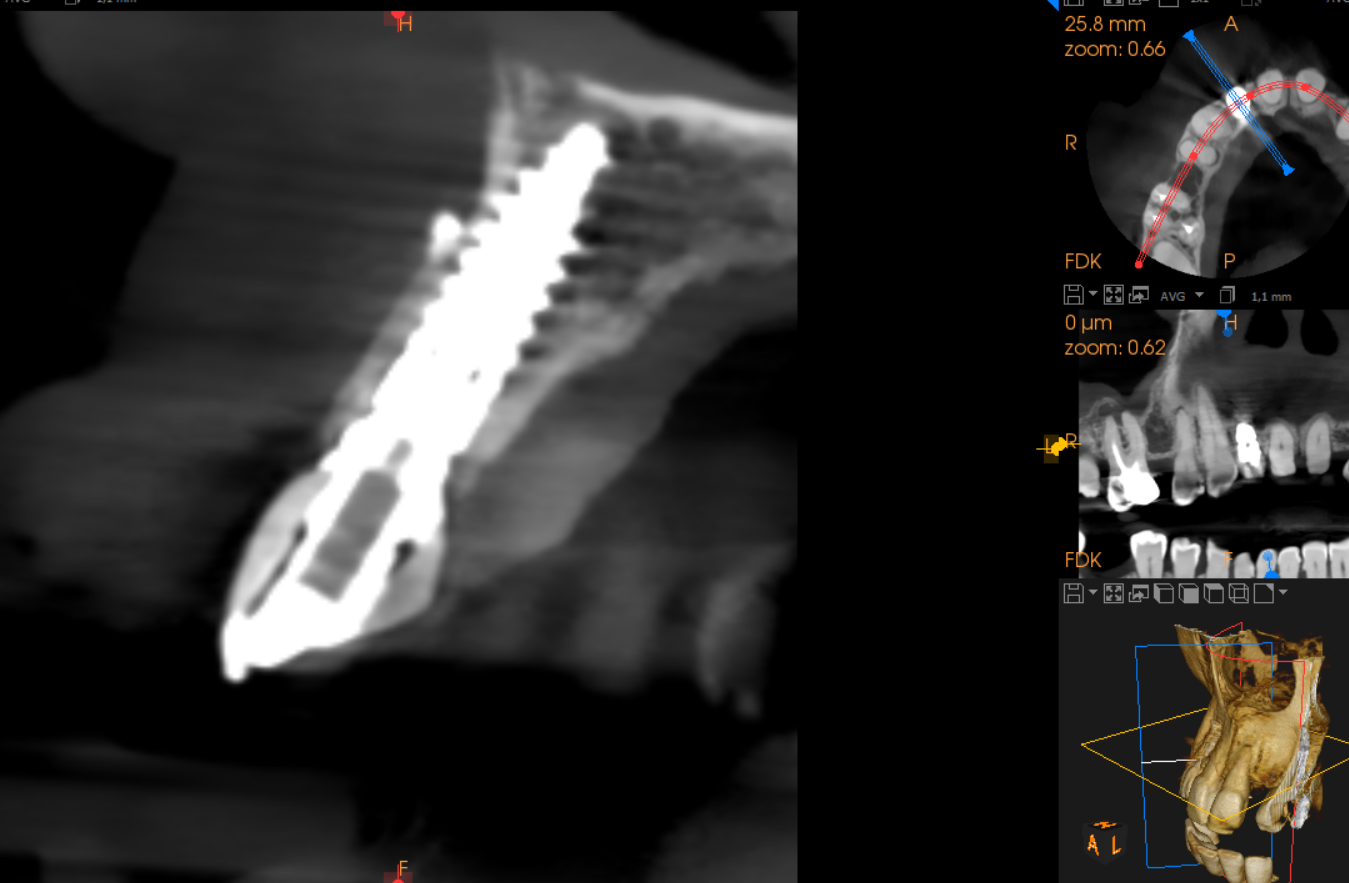 DLP SLA LCD 3d printer permenant crown - teeth resin ..