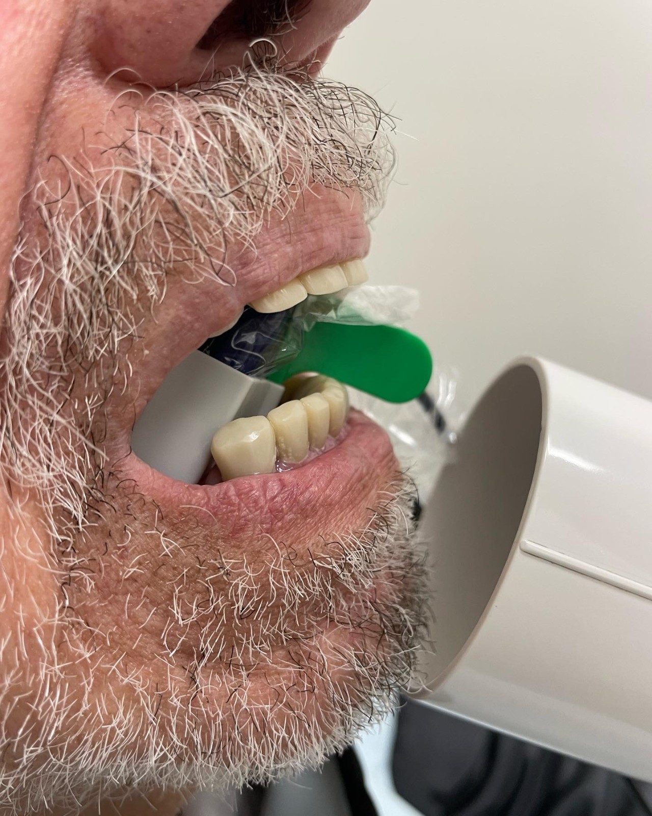 60 pcs Autoclavable - Apical/Bitewing Adult Digital Sensor Positioner-Holder