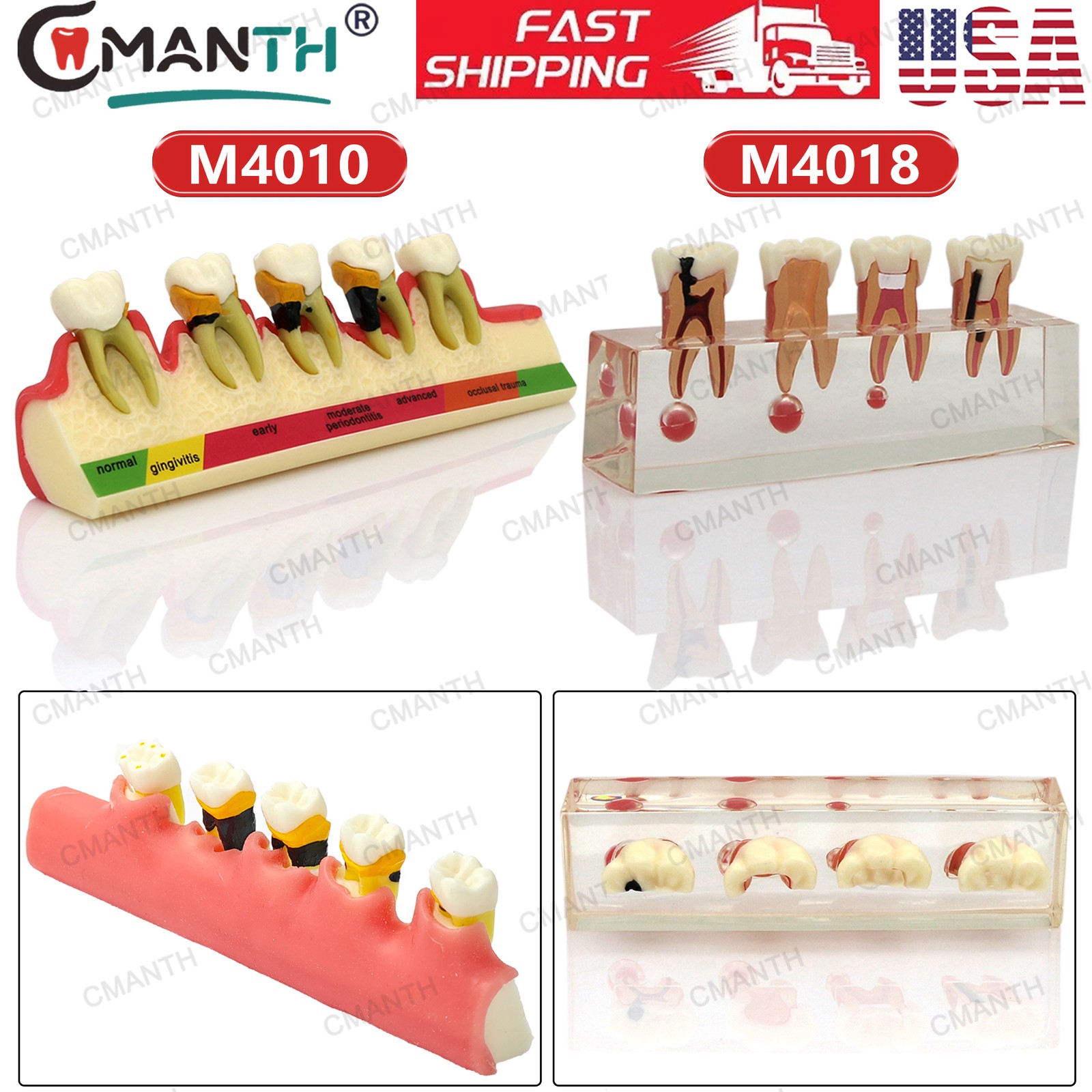 US Dental Teeth Model Periodontal Disease Assort Model 4 5-Stage Endodontic Demo