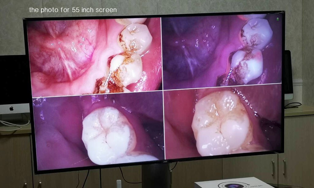 New 1080P Intraoral Camera For Decayed Tooth/Dental Calculas And Plaque MD4000B
