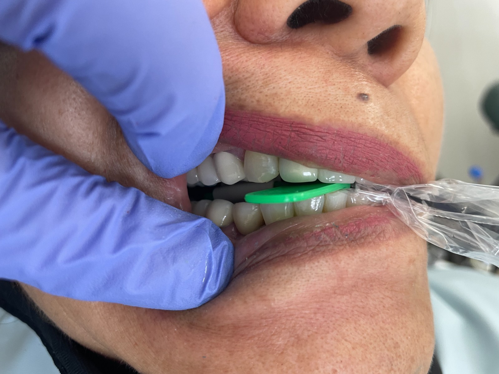 60 pcs Autoclavable - Apical/Bitewing Adult Digital Sensor Positioner-Holder