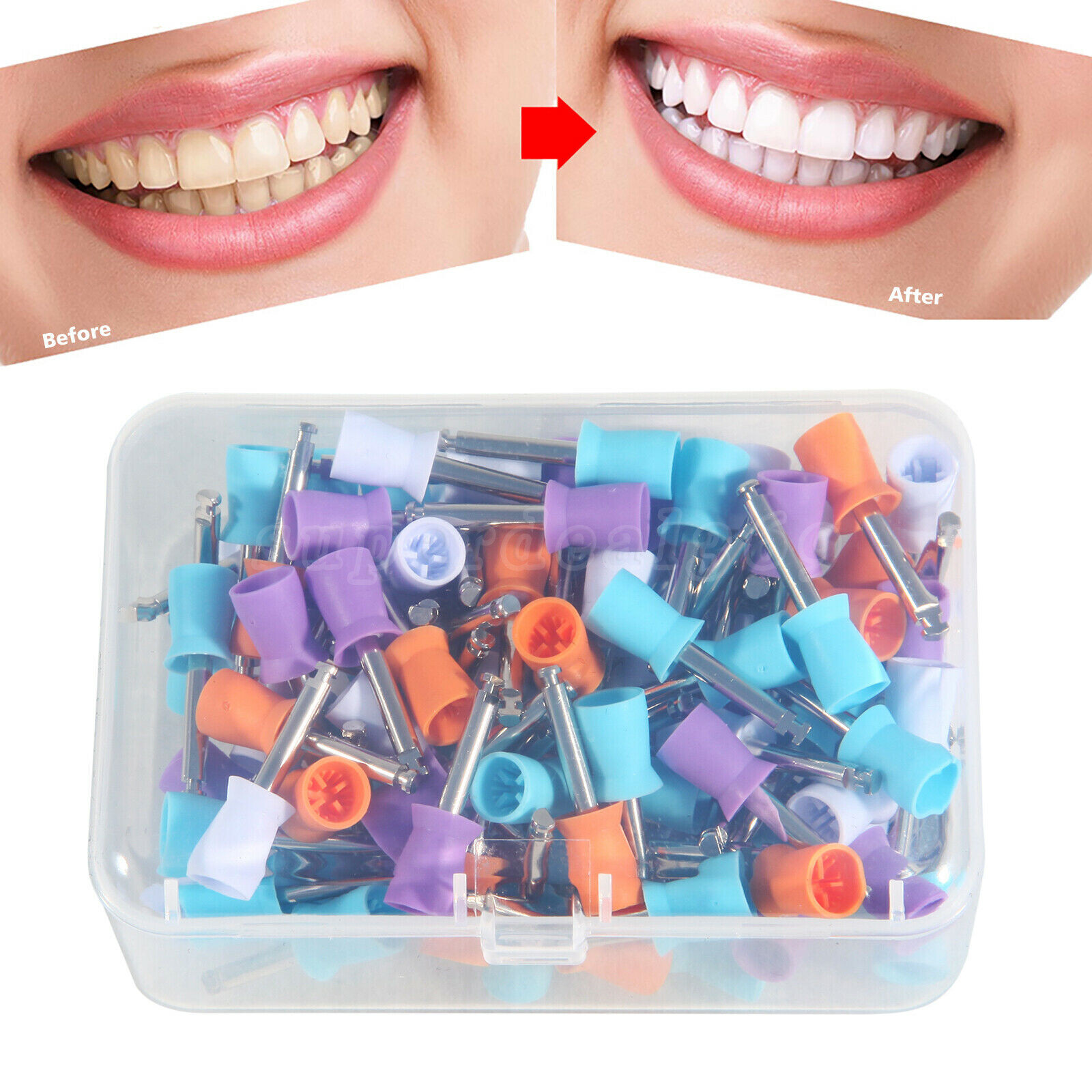 100PCS Mixed Dental Prophy Tooth Polishing Cups Latch Type Rubber Disposable
