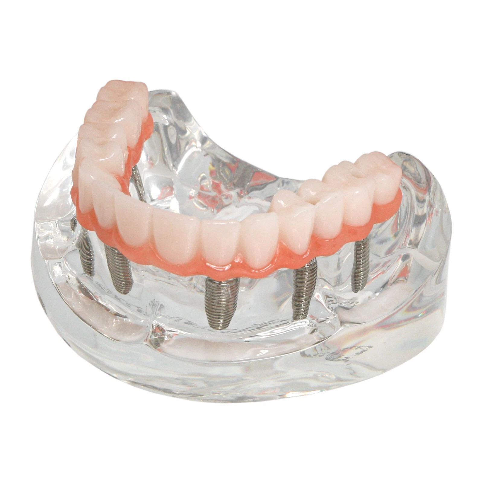 Dental Implant Restoration Model Upper Jaw 6 Screws Post Core Bridges M6001-2 US