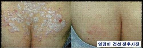 One ISAL Atopy Eczema Cream Lotion./Made in USA