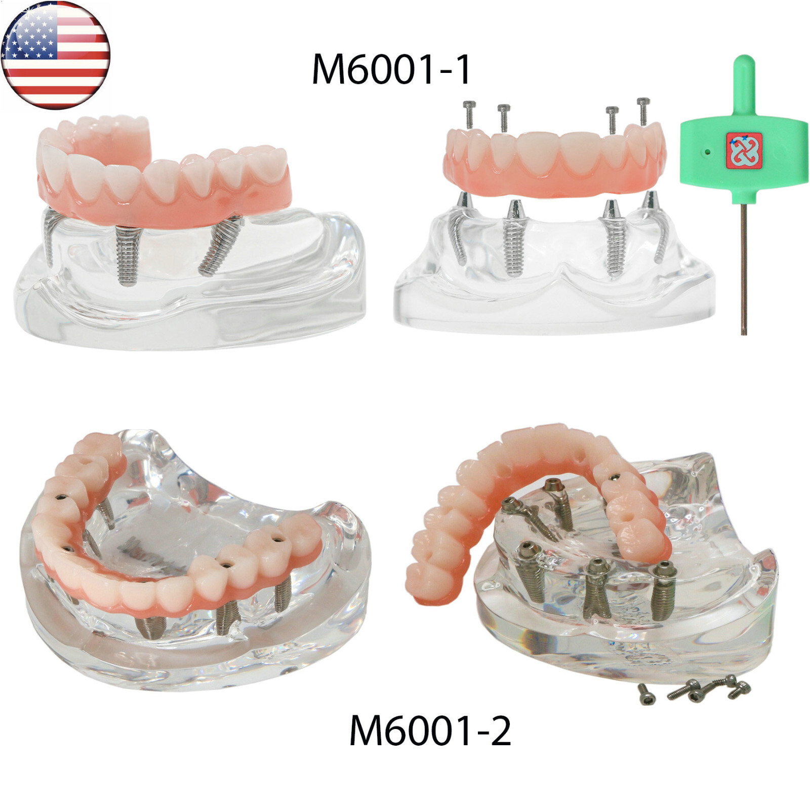 US Dental All-on-4/6 Screws Overdenture Implant  Model Upper Jaw Restoration