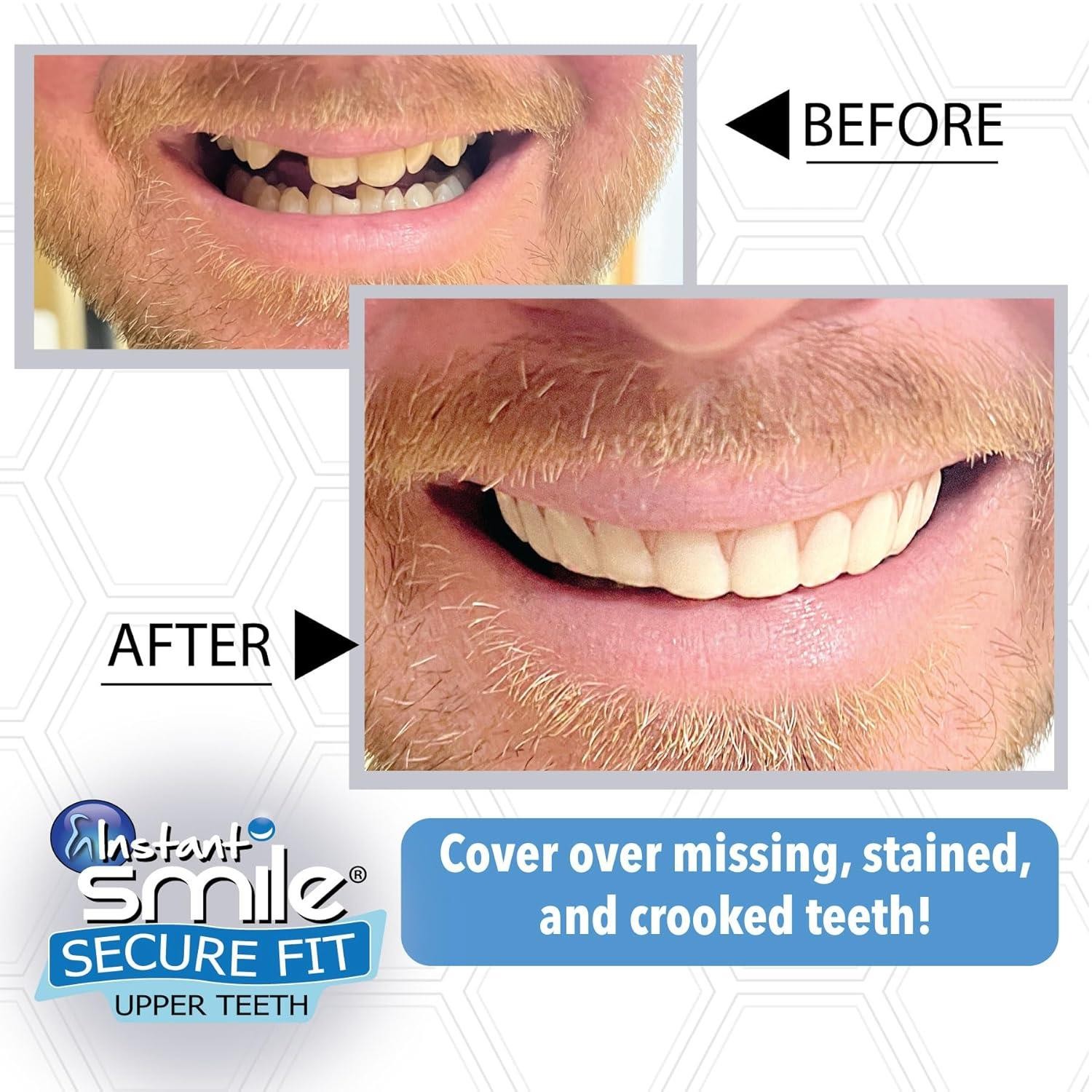 Just Released - Instant Smile Secure Fit Upper Teeth Veneer - Natural Shade