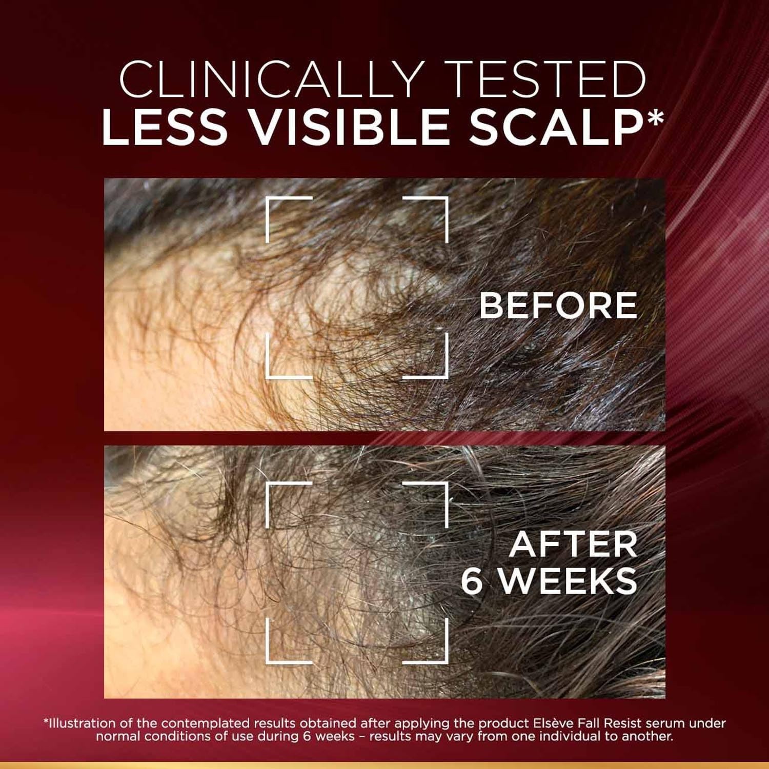 L'Oréal Fall Resist Serum 102ml with Aminexil, reduces hair fall I FREE SHIPPING