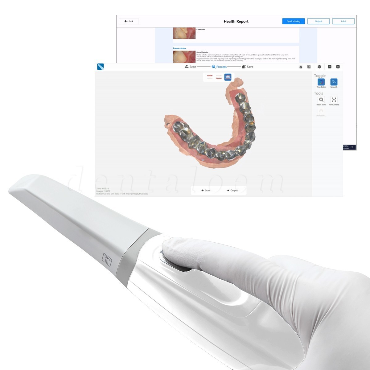 Dental Intraoral Scanner for CAD/CAM Restorative Dentistry