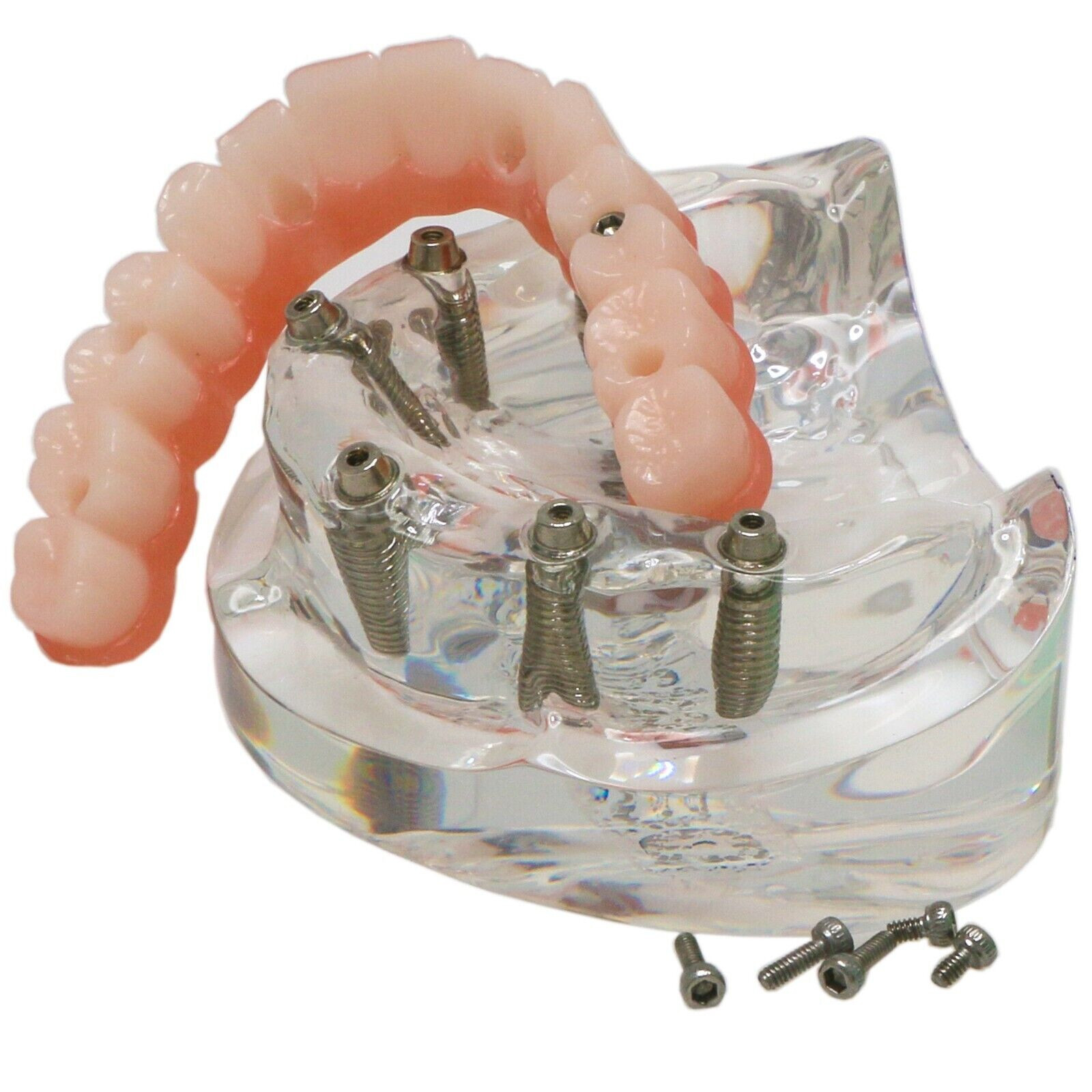 Dental All-On-6 Overdenture Implant Model Demo Upper Jaw 6 Screws Clear M6001-2