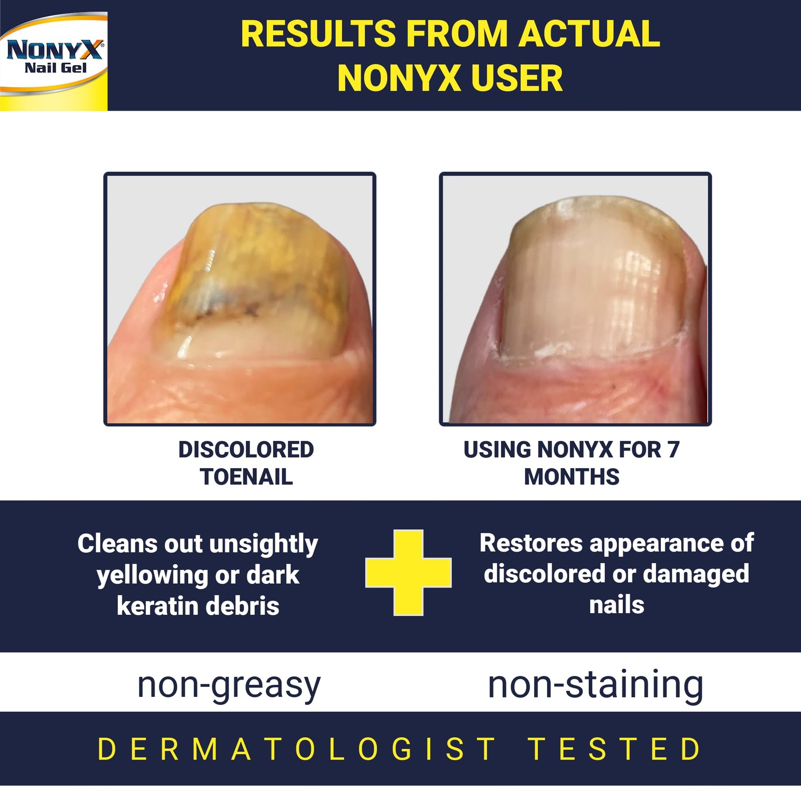 NONYX Fungal Nail Clarifying Gel - Discolored, Thick, Brittle Nails