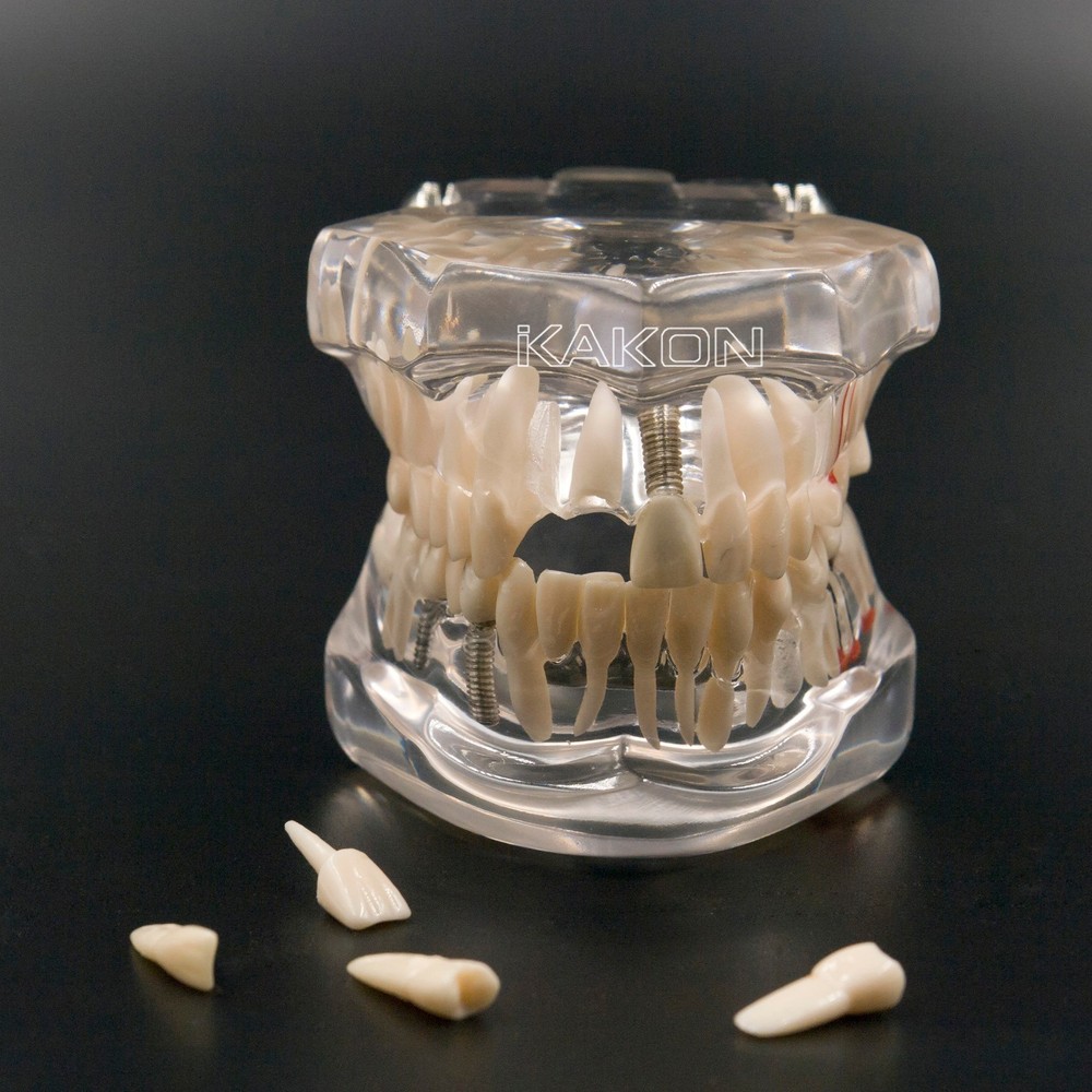 Dental Implant and Restoration Model Transparent Pathological Teeth Study Model