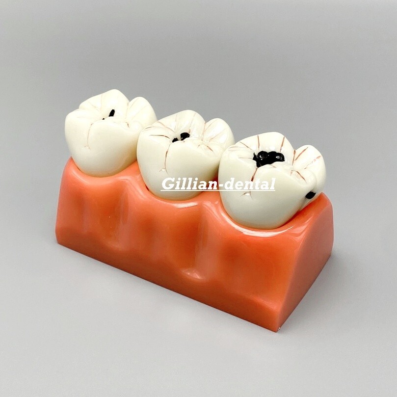 4 Times Caries Comparation Models Dental Detachable Abutment Teach Study Model