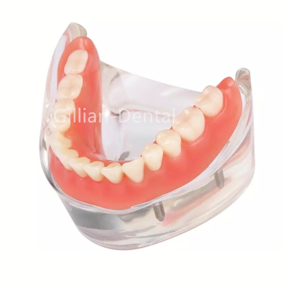 Dental Study Teach Teeth Model With Overdenture Inferior Demo 4 Implants