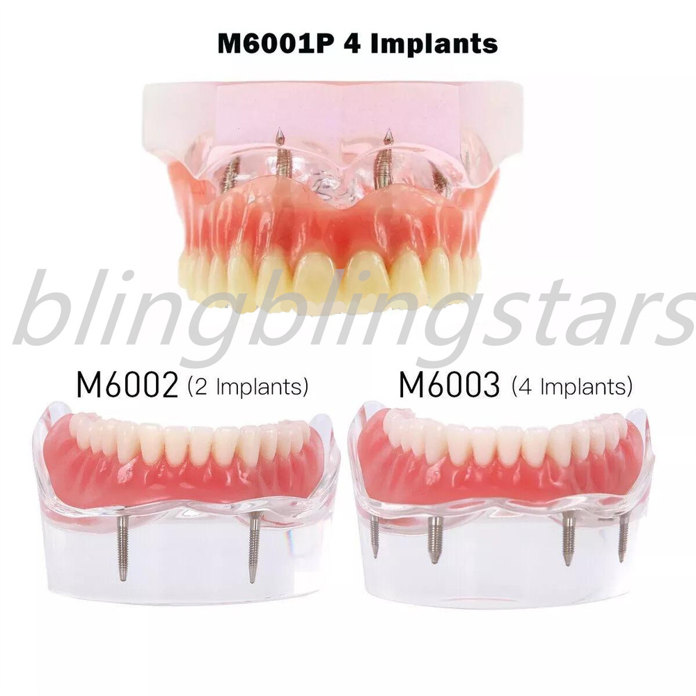 Dental Restoration Teeth Typodont Implants Model Demonstrate Overdenture 3 Model