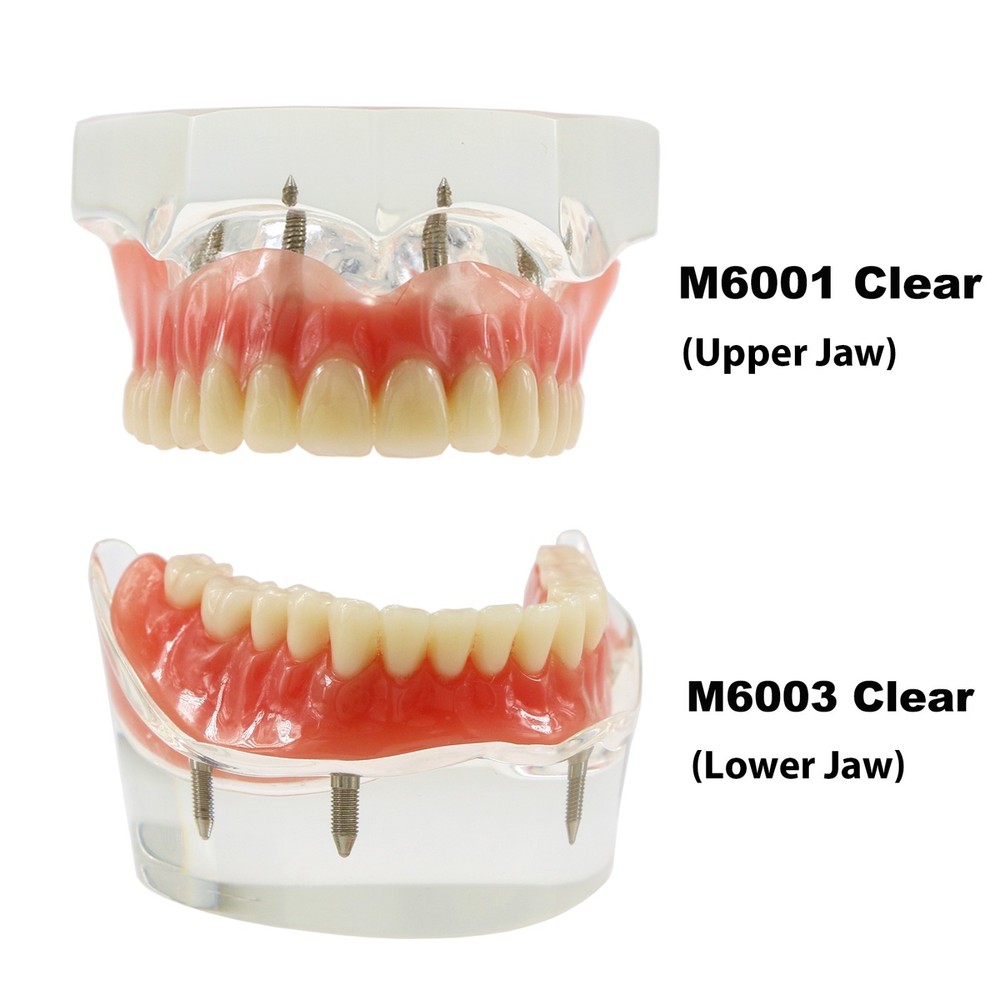 Dental Teeth Model Overdenture Removable Teeth Upper/Lower Jaw 4 Implants Model