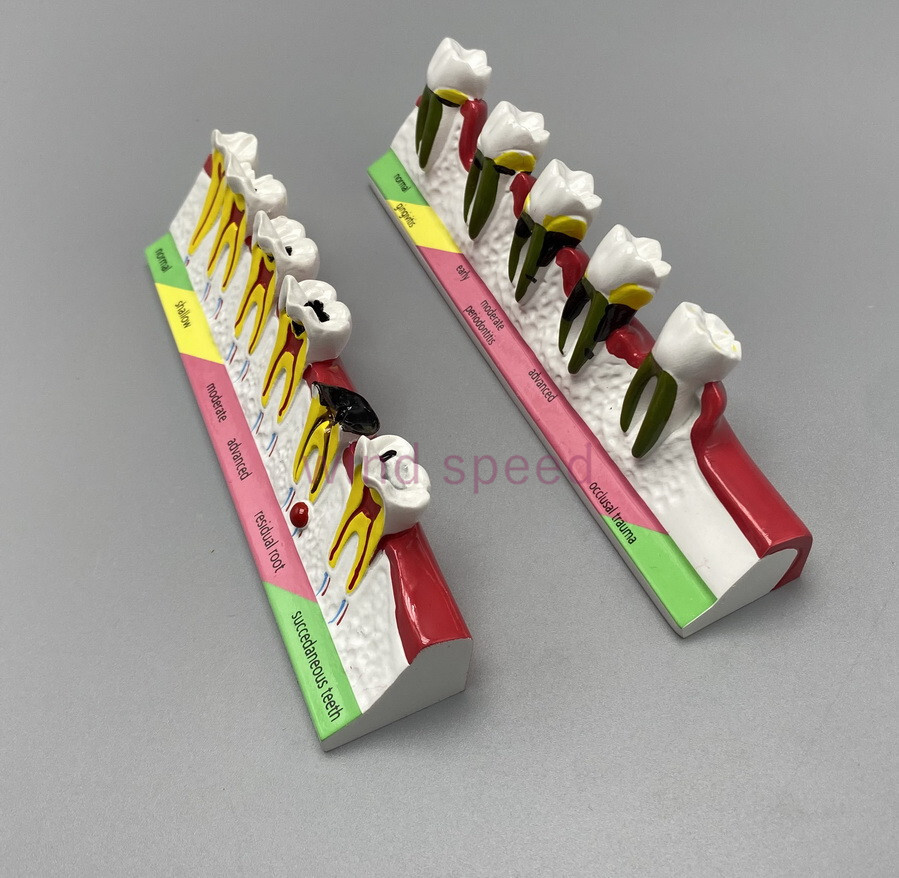 Dental Teeth Dentoform Typodont Caries Periodontal Disease Study Teaching Model