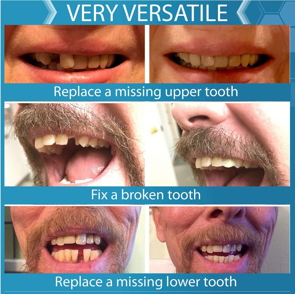 Complete Your Smile Temporary Tooth Replacement Kit - Replace a Missing Tooth in