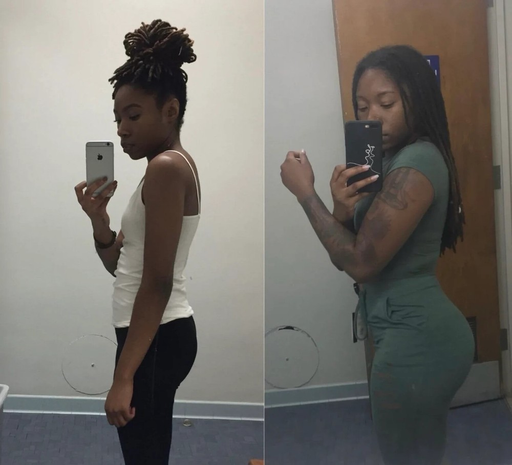 BBL Hips & Butt Enlargement bundle 7 days Results