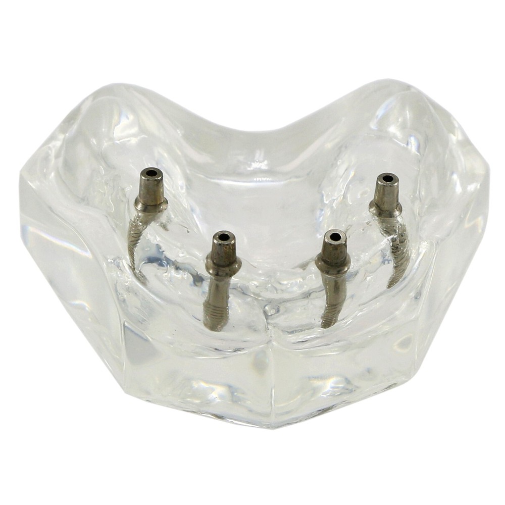 Detal Typondont Restoration Implant Overdenture Teeth Model 2 4 Implants